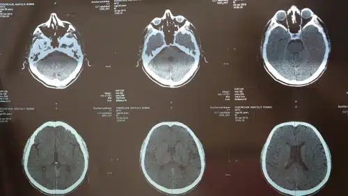 An MRI shows traumatic brain jury effects. 