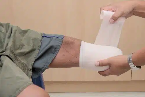 A man's leg is bandaged by a doctor after a amputation from an accident.